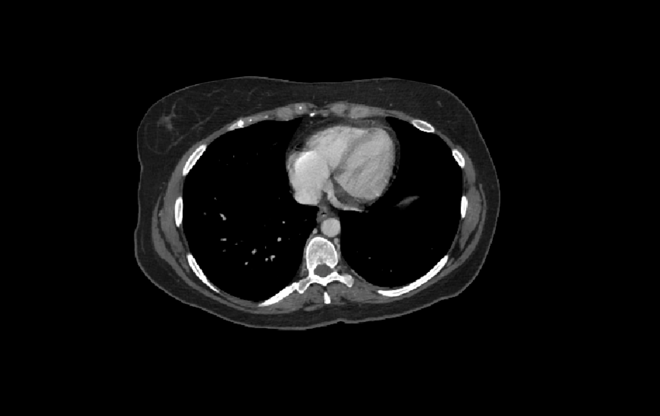 CT lliver lobes axial cross sectional anatomy labelled image -00081.webp